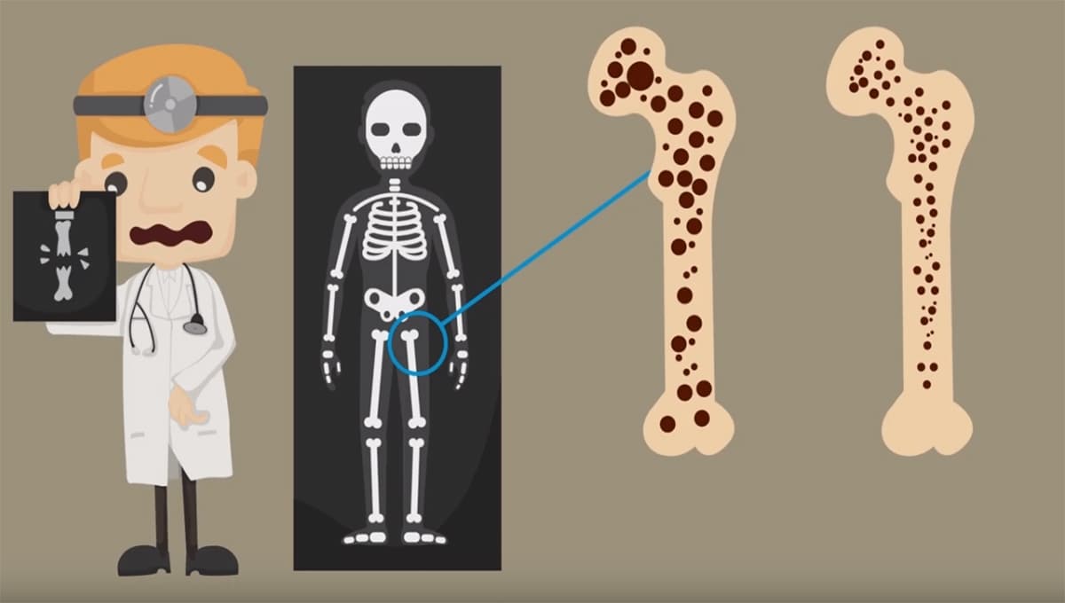 5 claves para prevenir la osteoporosis