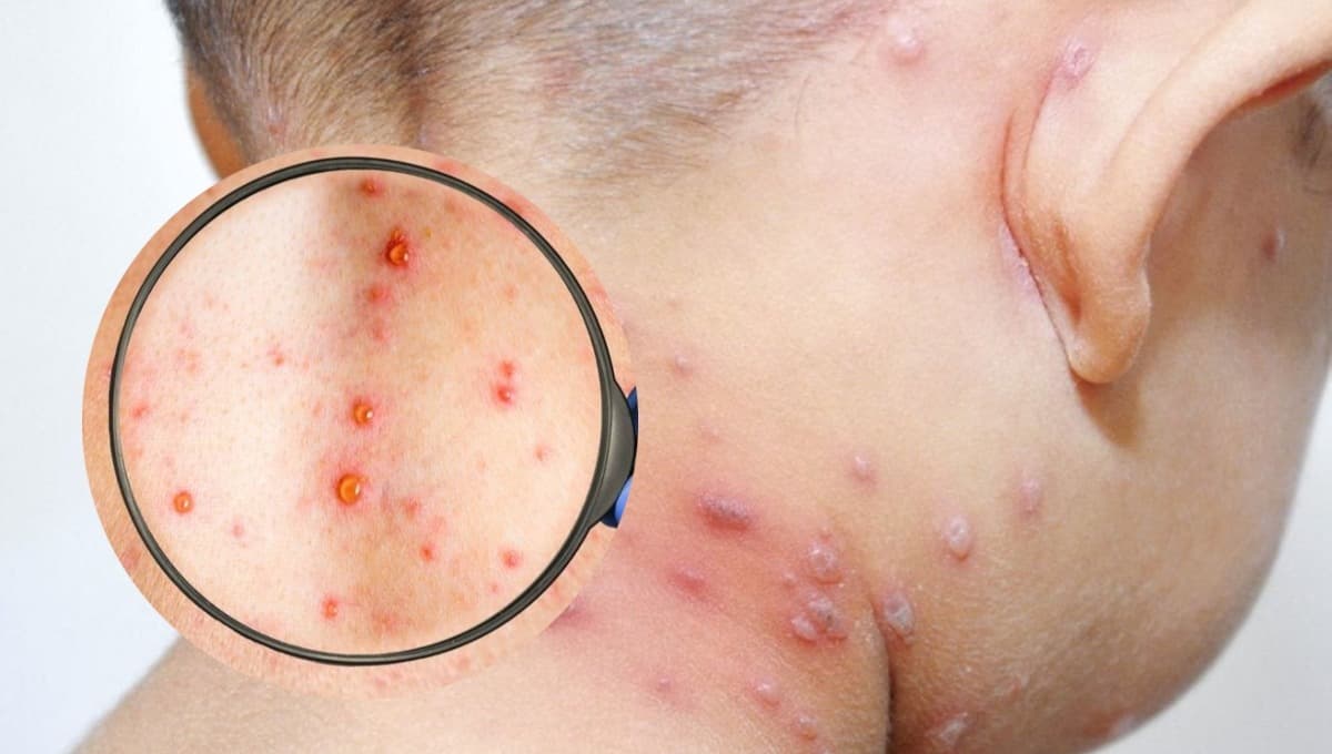 ¿Cómo se contagia la viruela del mono?