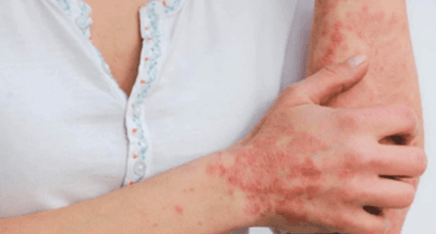 Viruela del Mono: 4 recomendaciones de la UNAM para evitar contagios