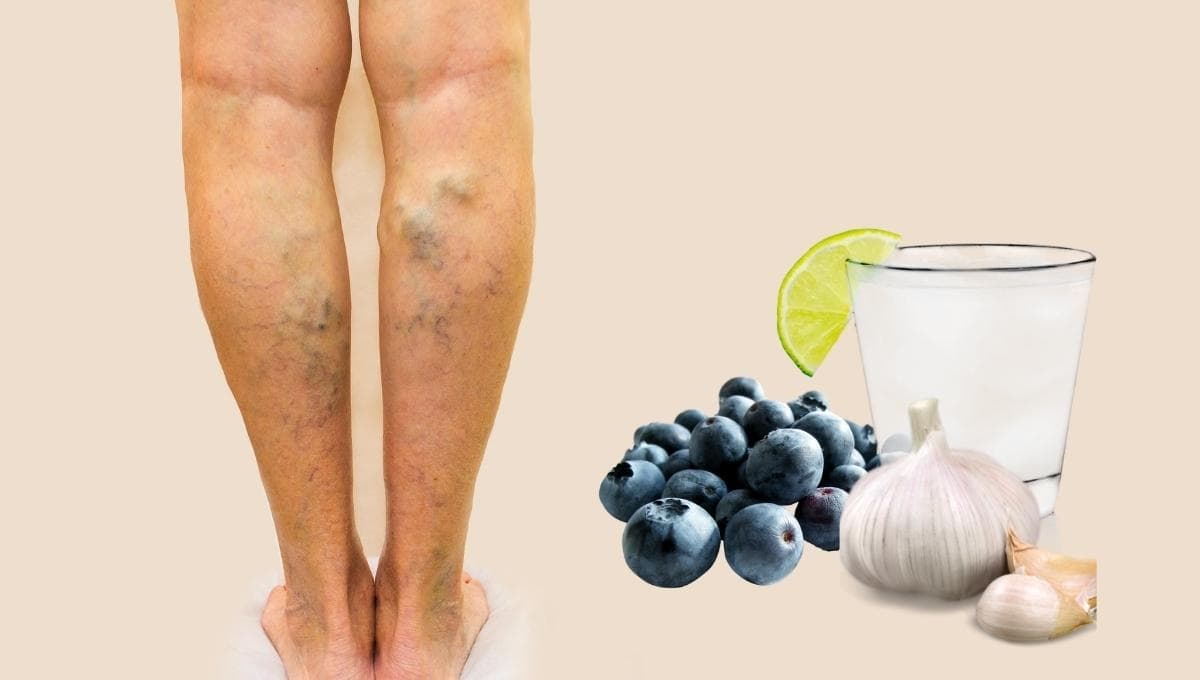 ¿Cómo reducir las varices de forma natural?