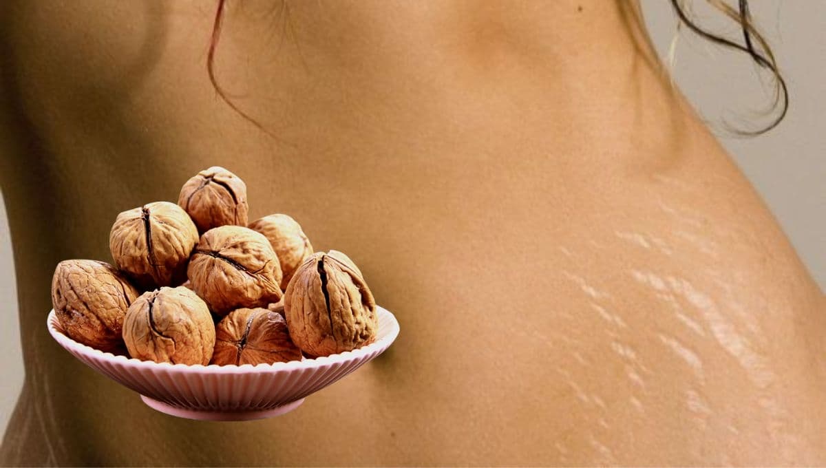 5 alimentos para prevenir y reducir la aparición de estrías en la piel