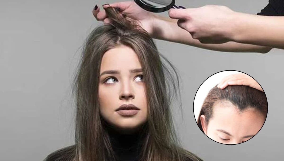 ¿Cómo hacer crecer el cabello en zonas calvas?
