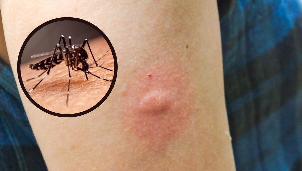 ¿Cómo calmar la picazón de las picaduras de mosquitos con remedios caseros?