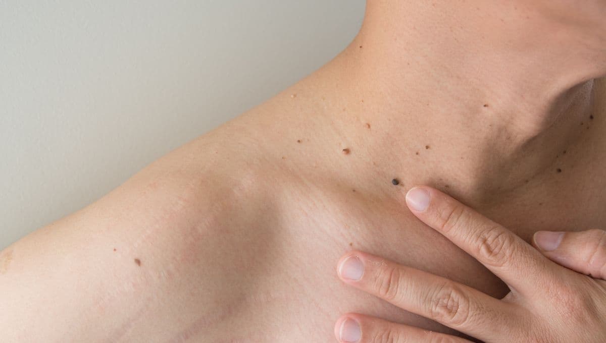 Verrugas en el cuello: por qué salen y cómo eliminarlas de la piel