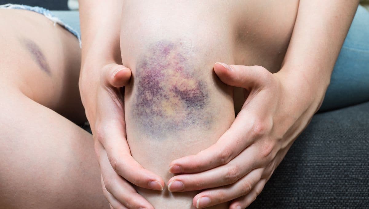 Moretones sin razón: por qué salen y cómo saber si es por una enfermedad