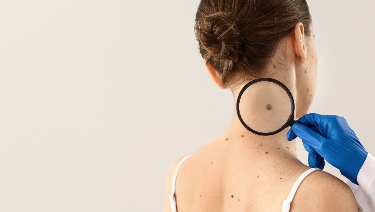 ¿Lunar o melanoma? Conoce las diferencias y cómo saber si es maligno